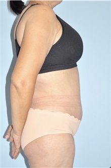 Body Contouring After Photo by Keyian Paydar, MD, FACS; Newport Beach, CA - Case 51223
