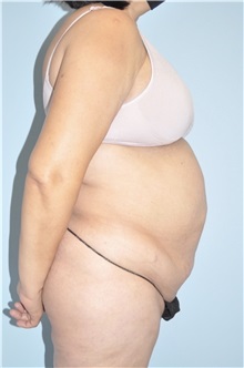 Body Contouring Before Photo by Keyian Paydar, MD, FACS; Newport Beach, CA - Case 51223