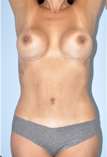 Body Contouring After Photo by Keyian Paydar, MD, FACS; Newport Beach, CA - Case 51240