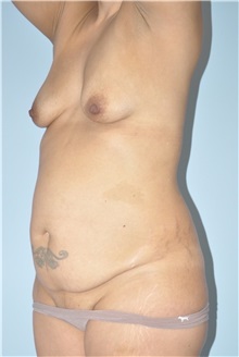 Body Contouring Before Photo by Keyian Paydar, MD, FACS; Newport Beach, CA - Case 51240