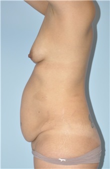 Body Contouring Before Photo by Keyian Paydar, MD, FACS; Newport Beach, CA - Case 51240