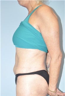 Body Contouring After Photo by Keyian Paydar, MD, FACS; Newport Beach, CA - Case 51213