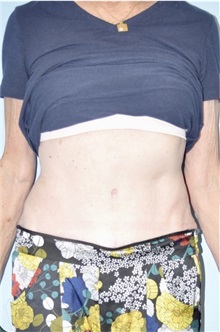 Body Contouring After Photo by Keyian Paydar, MD, FACS; Newport Beach, CA - Case 51222
