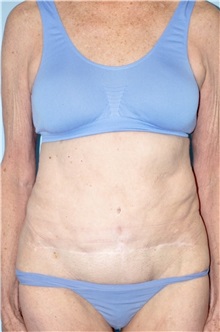 Body Contouring Before Photo by Keyian Paydar, MD, FACS; Newport Beach, CA - Case 51222