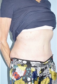 Body Contouring After Photo by Keyian Paydar, MD, FACS; Newport Beach, CA - Case 51222