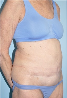 Body Contouring Before Photo by Keyian Paydar, MD, FACS; Newport Beach, CA - Case 51222