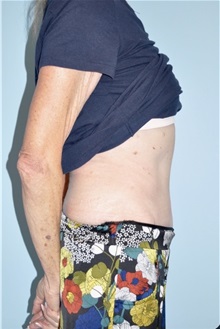 Body Contouring After Photo by Keyian Paydar, MD, FACS; Newport Beach, CA - Case 51222