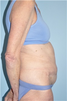 Body Contouring Before Photo by Keyian Paydar, MD, FACS; Newport Beach, CA - Case 51222