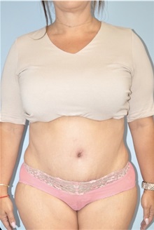 Body Contouring After Photo by Keyian Paydar, MD, FACS; Newport Beach, CA - Case 51229