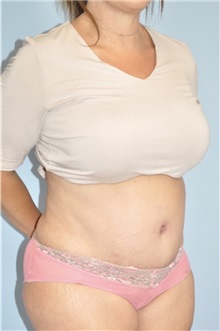 Body Contouring After Photo by Keyian Paydar, MD, FACS; Newport Beach, CA - Case 51229