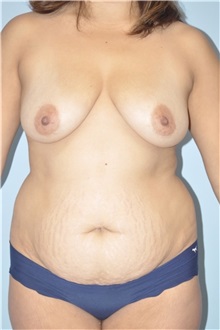 Body Contouring Before Photo by Keyian Paydar, MD, FACS; Newport Beach, CA - Case 51225