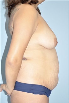 Body Contouring Before Photo by Keyian Paydar, MD, FACS; Newport Beach, CA - Case 51225
