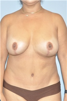 Body Contouring After Photo by Keyian Paydar, MD, FACS; Newport Beach, CA - Case 51230