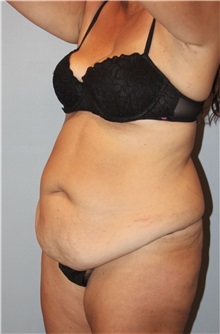 Body Contouring Before Photo by Keyian Paydar, MD, FACS; Newport Beach, CA - Case 51238