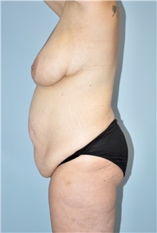 Body Contouring Before Photo by Keyian Paydar, MD, FACS; Newport Beach, CA - Case 51242