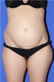 Body Contouring Before Photo by Keyian Paydar, MD, FACS; Newport Beach, CA - Case 51236