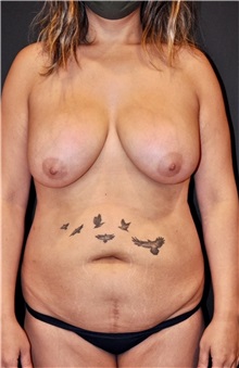 Body Contouring Before Photo by Keyian Paydar, MD, FACS; Newport Beach, CA - Case 51231