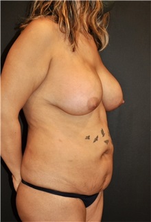 Body Contouring Before Photo by Keyian Paydar, MD, FACS; Newport Beach, CA - Case 51231