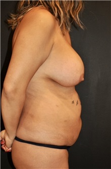 Body Contouring Before Photo by Keyian Paydar, MD, FACS; Newport Beach, CA - Case 51231