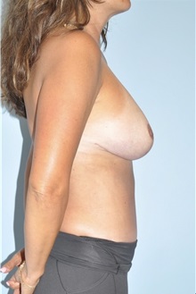 Body Contouring After Photo by Keyian Paydar, MD, FACS; Newport Beach, CA - Case 51234