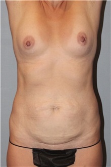 Body Contouring Before Photo by Keyian Paydar, MD, FACS; Newport Beach, CA - Case 51237