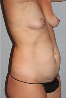 Body Contouring Before Photo by Keyian Paydar, MD, FACS; Newport Beach, CA - Case 51237
