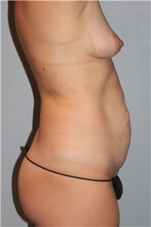 Body Contouring Before Photo by Keyian Paydar, MD, FACS; Newport Beach, CA - Case 51237