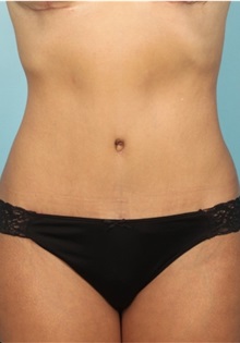 Body Contouring After Photo by Keyian Paydar, MD, FACS; Newport Beach, CA - Case 51241
