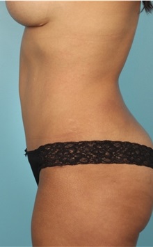 Body Contouring After Photo by Keyian Paydar, MD, FACS; Newport Beach, CA - Case 51241