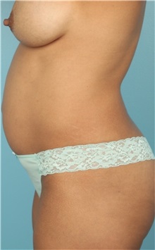 Body Contouring Before Photo by Keyian Paydar, MD, FACS; Newport Beach, CA - Case 51241