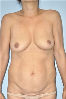 Body Contouring Before Photo by Keyian Paydar, MD, FACS; Newport Beach, CA - Case 51244