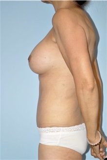Body Contouring After Photo by Keyian Paydar, MD, FACS; Newport Beach, CA - Case 51244