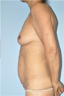 Body Contouring Before Photo by Keyian Paydar, MD, FACS; Newport Beach, CA - Case 51244