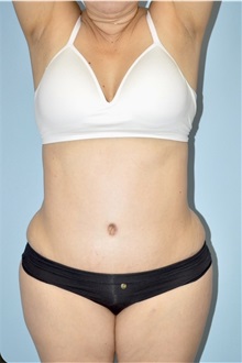 Tummy Tuck After Photo by Keyian Paydar, MD, FACS; Newport Beach, CA - Case 51275