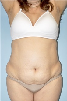 Tummy Tuck Before Photo by Keyian Paydar, MD, FACS; Newport Beach, CA - Case 51275