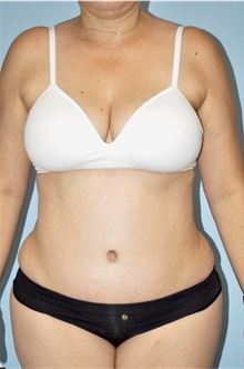 Tummy Tuck After Photo by Keyian Paydar, MD, FACS; Newport Beach, CA - Case 51275
