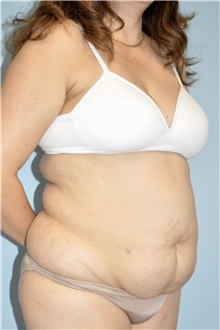 Liposuction Before Photo by Keyian Paydar, MD, FACS; Newport Beach, CA - Case 51274
