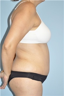 Liposuction After Photo by Keyian Paydar, MD, FACS; Newport Beach, CA - Case 51274