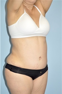 Liposuction After Photo by Keyian Paydar, MD, FACS; Newport Beach, CA - Case 51274
