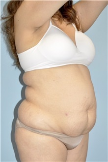 Liposuction Before Photo by Keyian Paydar, MD, FACS; Newport Beach, CA - Case 51274