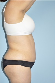 Liposuction After Photo by Keyian Paydar, MD, FACS; Newport Beach, CA - Case 51274