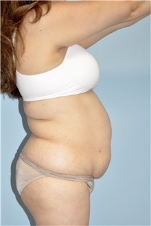Liposuction Before Photo by Keyian Paydar, MD, FACS; Newport Beach, CA - Case 51274