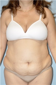 Body Contouring Before Photo by Keyian Paydar, MD, FACS; Newport Beach, CA - Case 51273