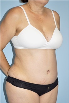 Body Contouring After Photo by Keyian Paydar, MD, FACS; Newport Beach, CA - Case 51273
