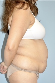 Body Contouring Before Photo by Keyian Paydar, MD, FACS; Newport Beach, CA - Case 51273