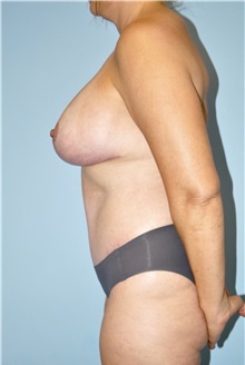 Mommy Makeover After Photo by Keyian Paydar, MD, FACS; Newport Beach, CA - Case 51535