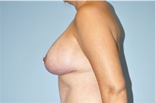 Breast Lift After Photo by Keyian Paydar, MD, FACS; Newport Beach, CA - Case 51533