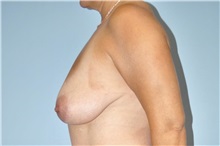 Breast Lift Before Photo by Keyian Paydar, MD, FACS; Newport Beach, CA - Case 51533