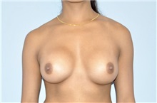 Breast Augmentation After Photo by Keyian Paydar, MD, FACS; Newport Beach, CA - Case 51536