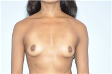 Breast Augmentation Before Photo by Keyian Paydar, MD, FACS; Newport Beach, CA - Case 51536